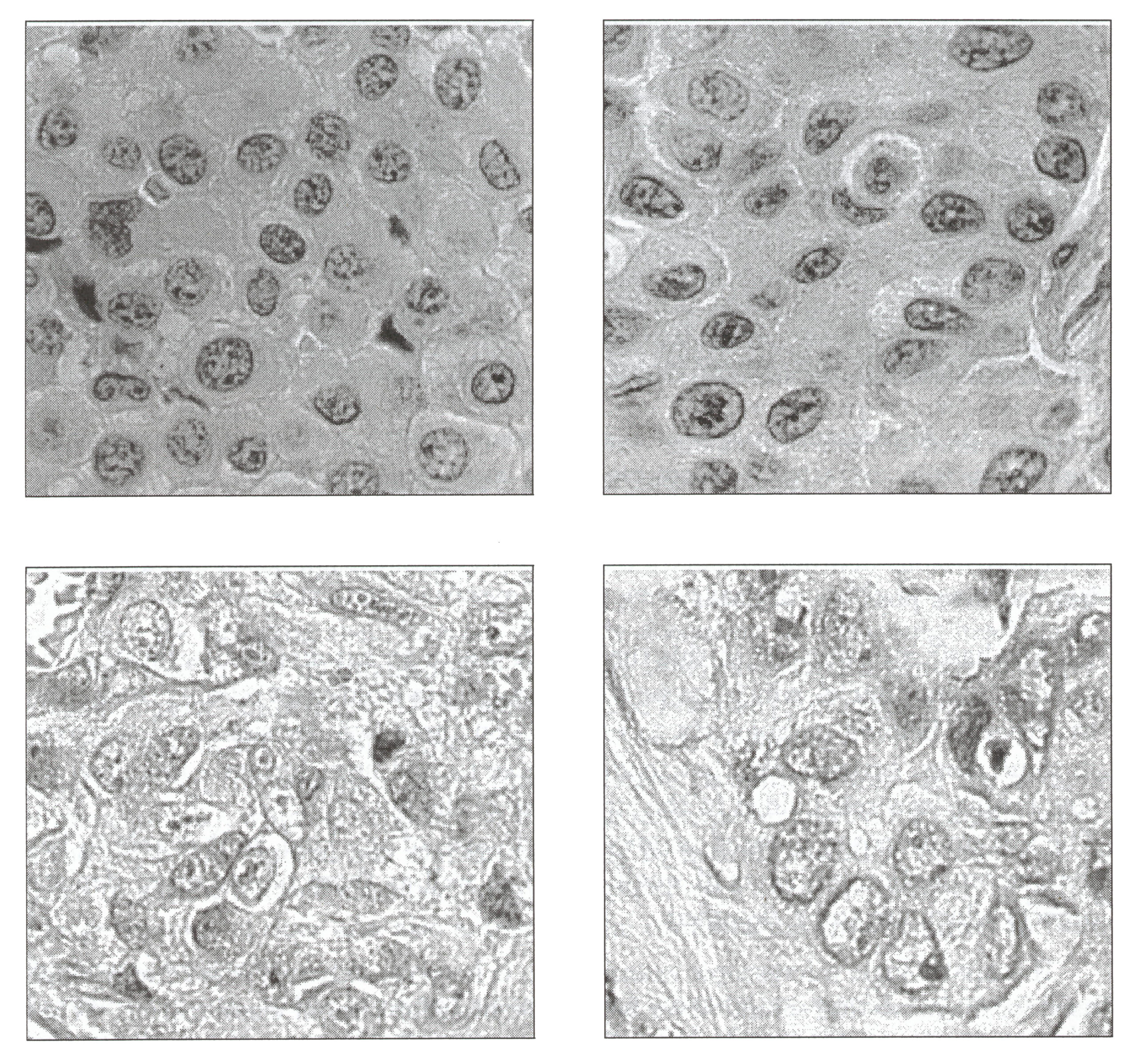 Blog 17 3 KI u IdM Mesotheliom Adenocarcinom 2020 08 27